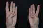 Post-trapeziectomy thumb flexion